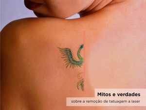 Mitos e verdades sobre a remoção de tatuagem a laser 2