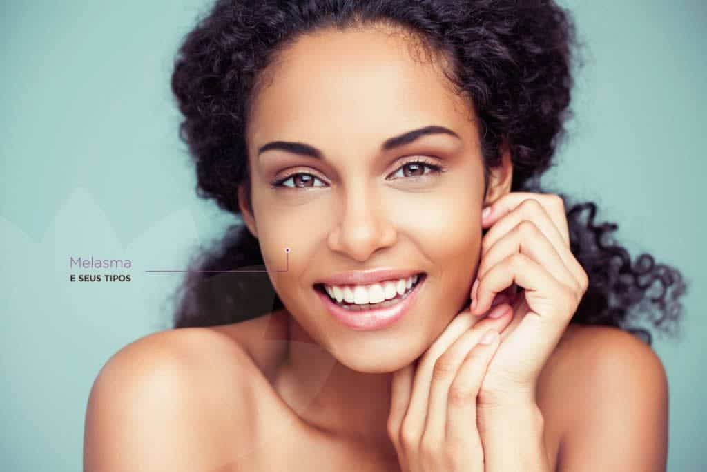 Tipos de Melasma 1