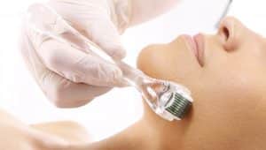 Você sabe o que é Microagulhamento?